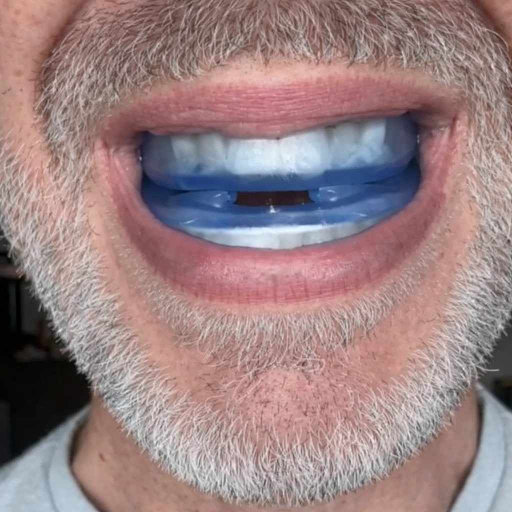 Trevalisse Anti-Snoring Mouthpiece Universal Size